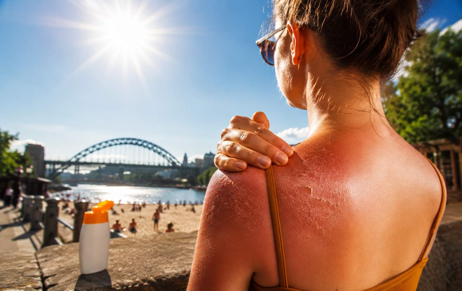 How to Prevent and Treat Painful Sunburn This Summer